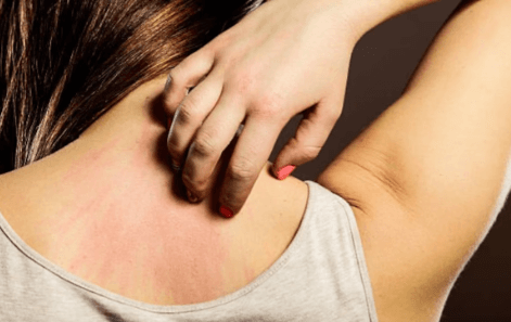 Best home remedies for curing Itching
