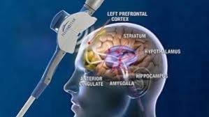 The Role of rTMS in Treating Treatment-Resistant Anxiety Disorders